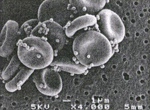 ブドウ状球菌を付着させた赤血球  イメージ